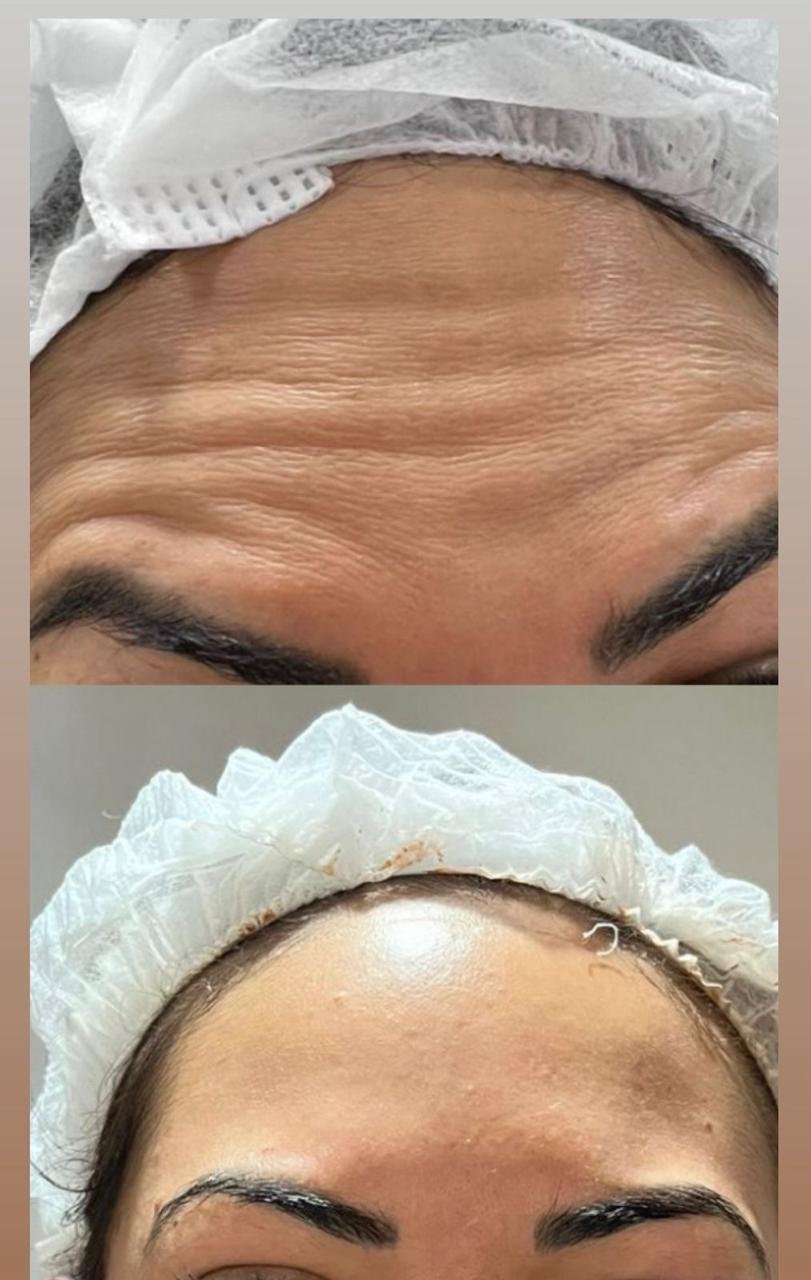 Aplicação de Botox